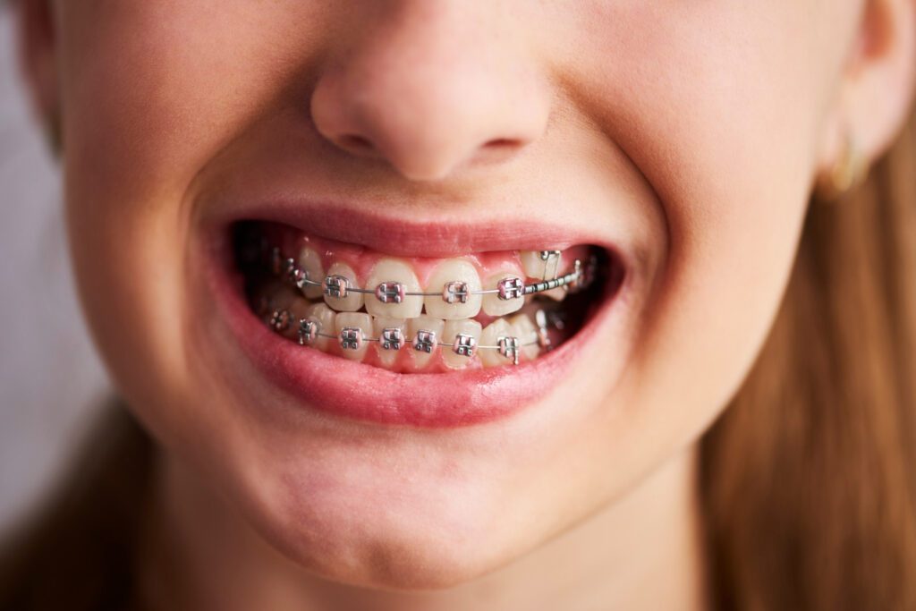 orthodontie mond van meisje